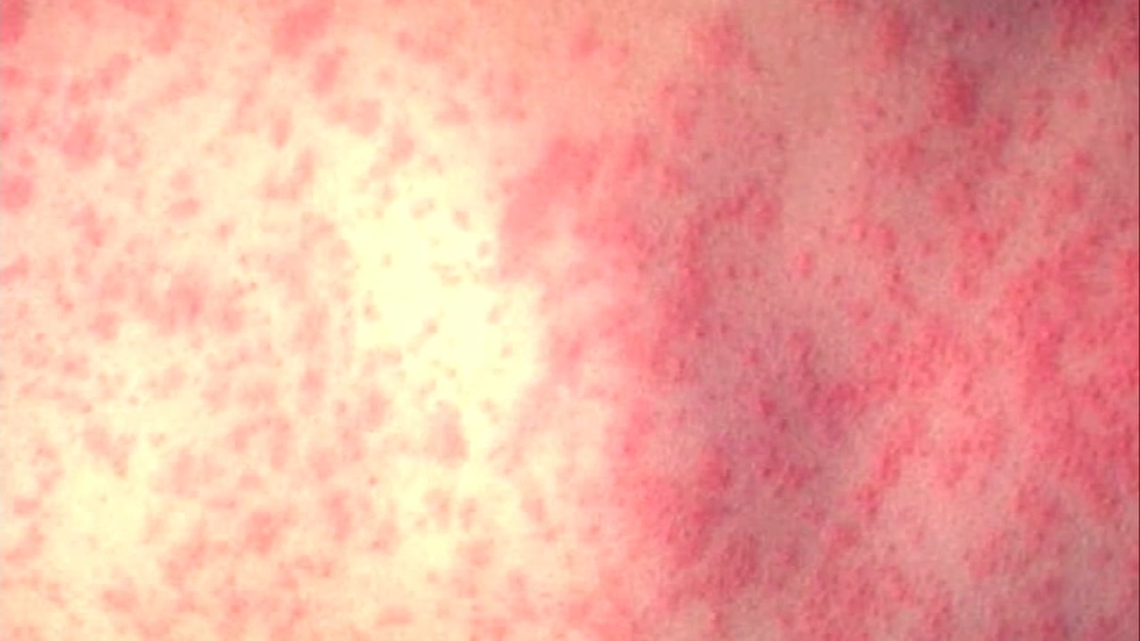 Another Measles Case In Virginia: Second Reported In 2025 Another Measles Case In Virginia: Second Reported In 2025