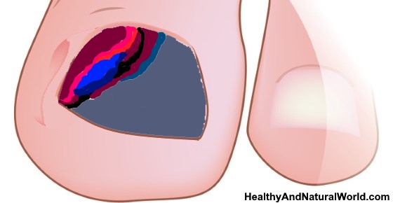 Bali Belly: Causes, Symptoms, And Effective Treatments Bali Belly: Causes, Symptoms, And Effective Treatments