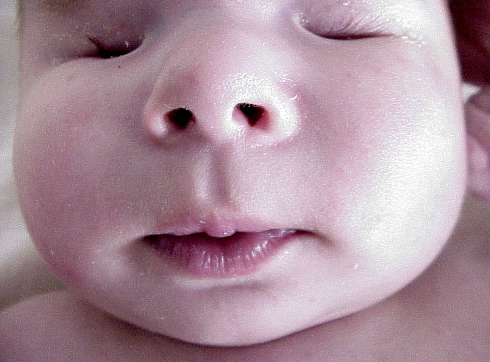 Bilateral Anophthalmia: Causes, Diagnosis, And Support For Affected Families Bilateral Anophthalmia: Causes, Diagnosis, And Support For Affected Families