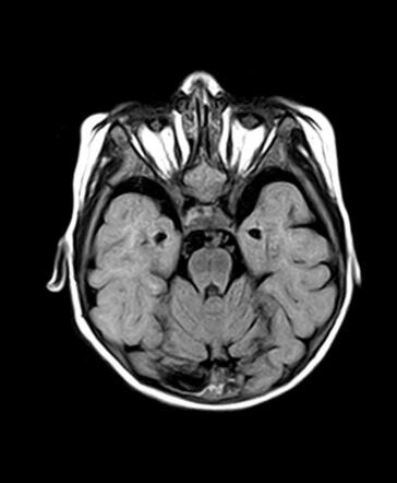 Bilateral Anophthalmia In Infants: Causes, Diagnosis, And Support Bilateral Anophthalmia In Infants: Causes, Diagnosis, And Support