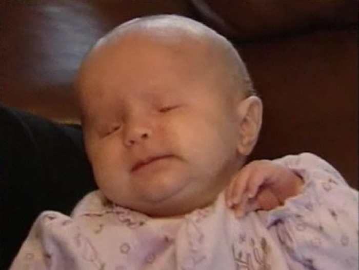 Bilateral Anophthalmia: Understanding The Rare Condition Of Babies Born Without Eyes Bilateral Anophthalmia: Understanding The Rare Condition Of Babies Born Without Eyes
