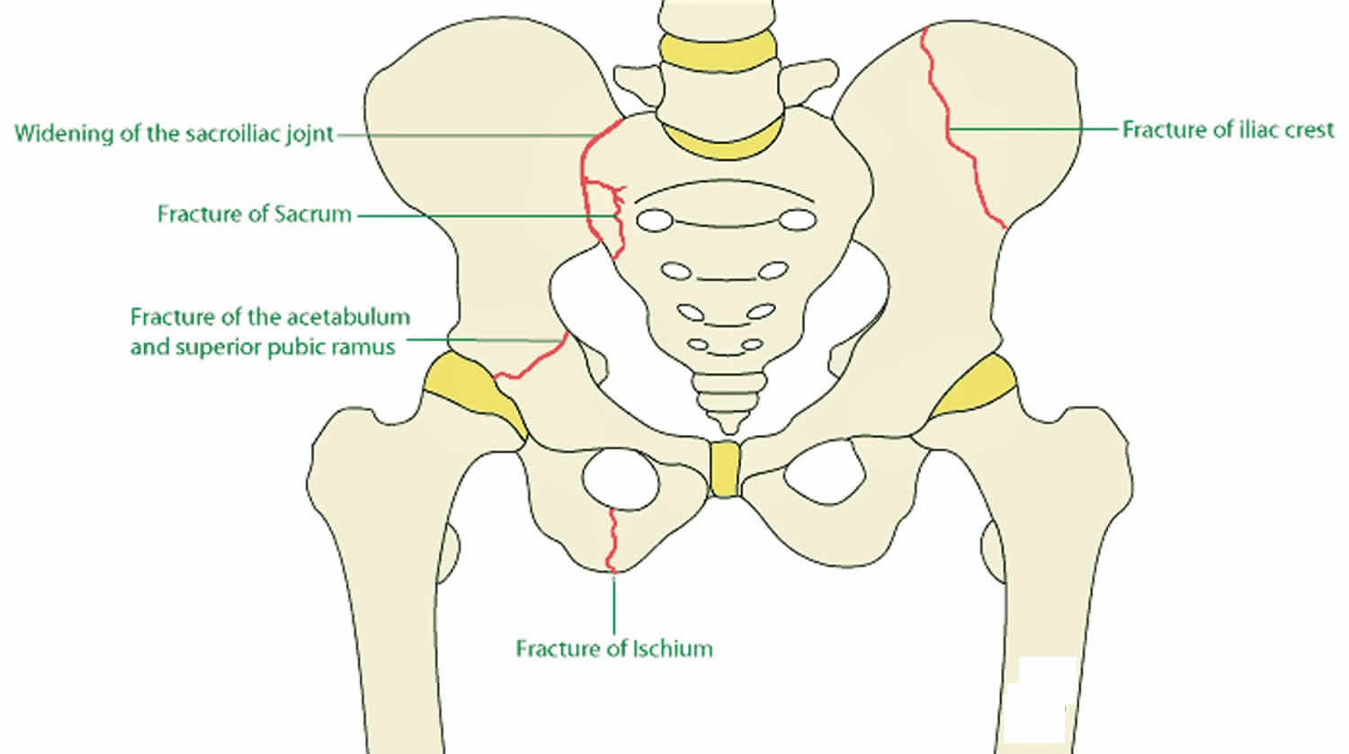Butler's Pelvic Contusion: Impact On Playoffs And Recovery Timeline