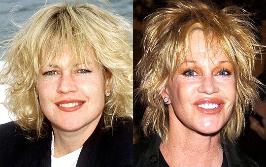 Facelift Gone Wrong? Public Outrage Over Actress's Altered Appearance Facelift Gone Wrong? Public Outrage Over Actress's Altered Appearance