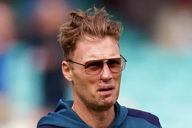 Freddie Flintoff's Healed Face: A Look After The Top Gear Crash Freddie Flintoff's Healed Face: A Look After The Top Gear Crash