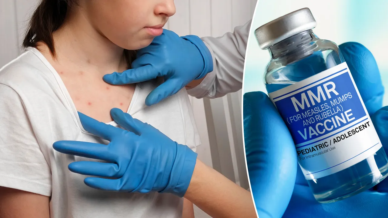 Israel Faces Measles Surge Following Texas Outbreak Israel Faces Measles Surge Following Texas Outbreak
