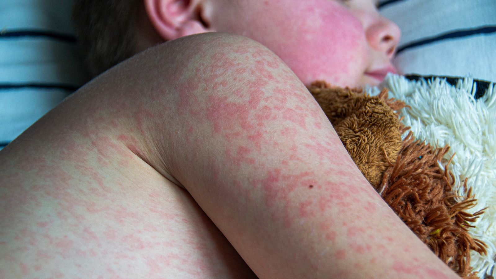 Measles Cases In The US: A Slowdown Explained Measles Cases In The US: A Slowdown Explained