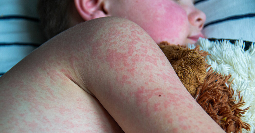 Measles Outbreak Sparks Urgent US Vaccine Monitoring Initiative Measles Outbreak Sparks Urgent US Vaccine Monitoring Initiative
