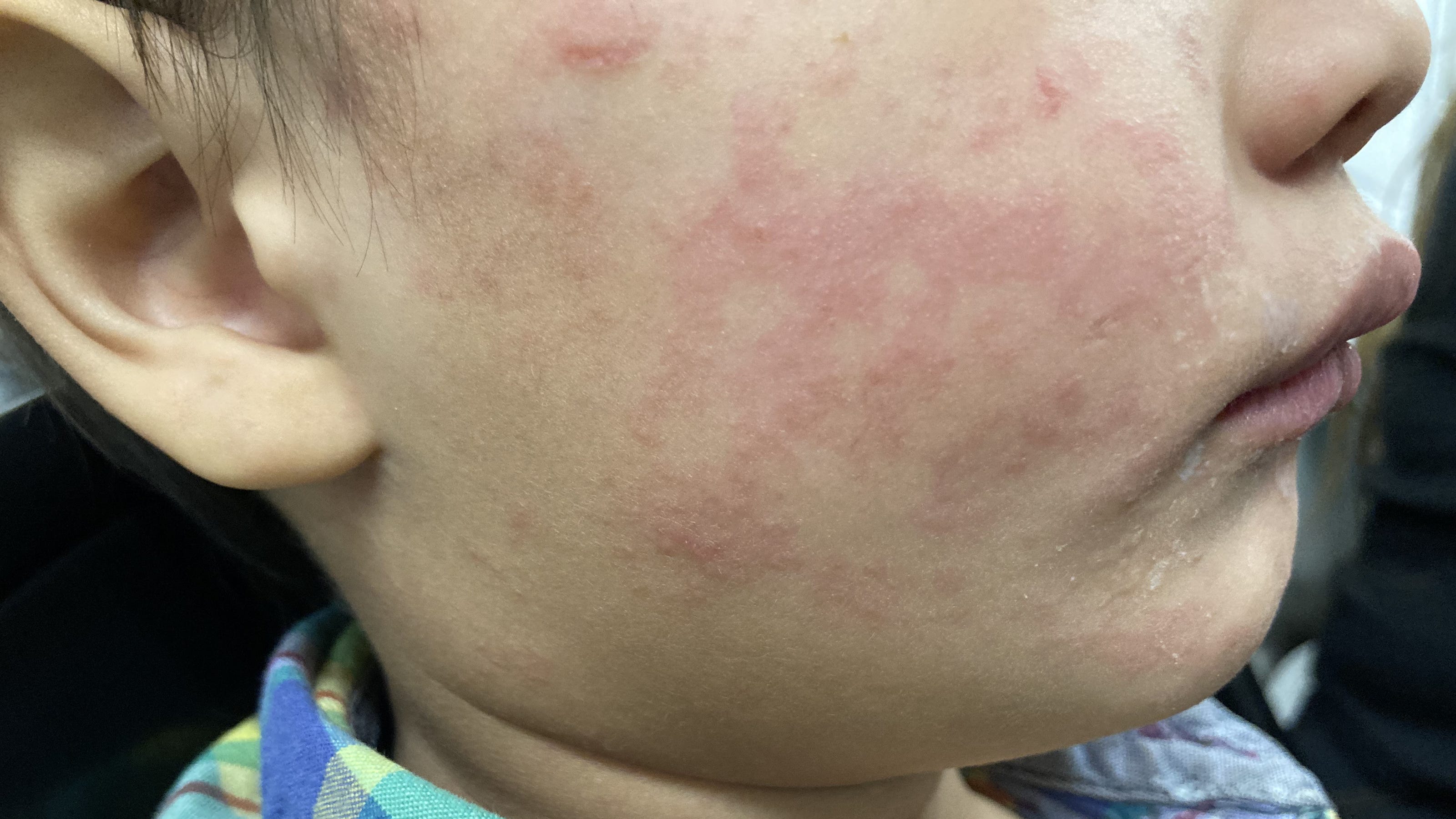 Texas Measles Cases Rise: New Infections Unrelated To Main Outbreak Texas Measles Cases Rise: New Infections Unrelated To Main Outbreak