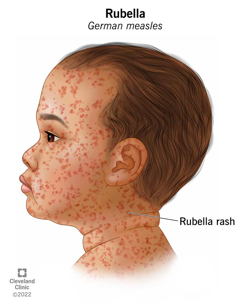 The Persistence Of Measles: Understanding Continued Transmission The Persistence Of Measles: Understanding Continued Transmission