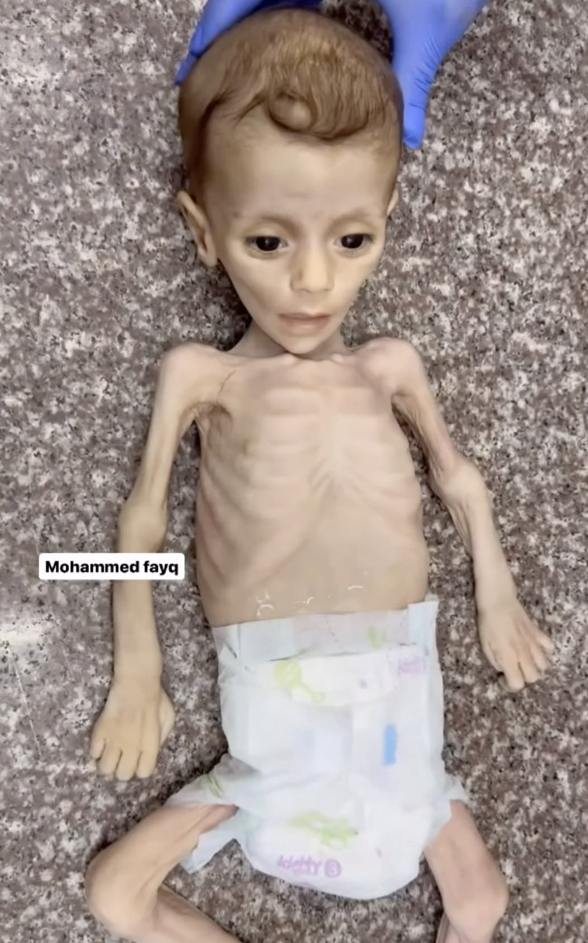 Ürdün, Gazze'deki Kanserli Çocukları Tedavi Ediyor Ürdün, Gazze'deki Kanserli Çocukları Tedavi Ediyor