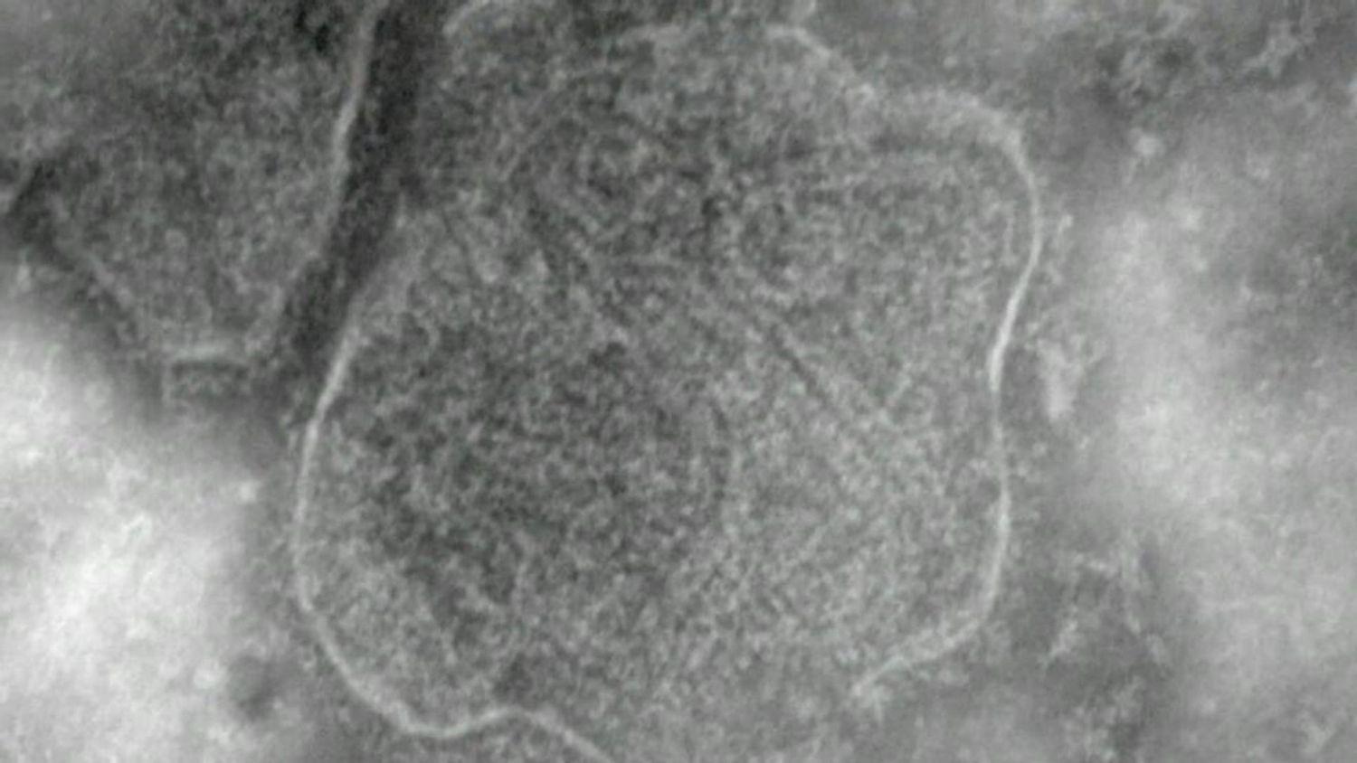 Update: Second Measles Case Confirmed In Virginia For 2025 Update: Second Measles Case Confirmed In Virginia For 2025